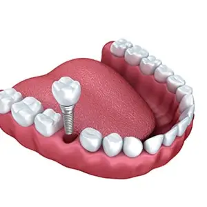 Dental Implants Sunset UT