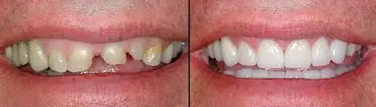 Sunset Utah Dental Crowns