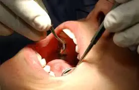 What Are Those Tools In The Dental Office? fluoride treatment UT