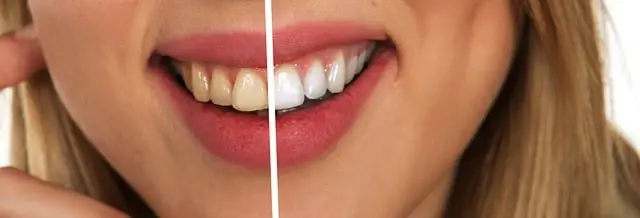 Why Trust Your Dentist For Teeth Whitening Instead Of Doing It At Home Sunset Dental cosmetic dentistry