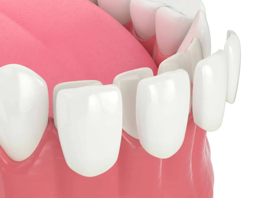 Dental veneers Sunset Utah
