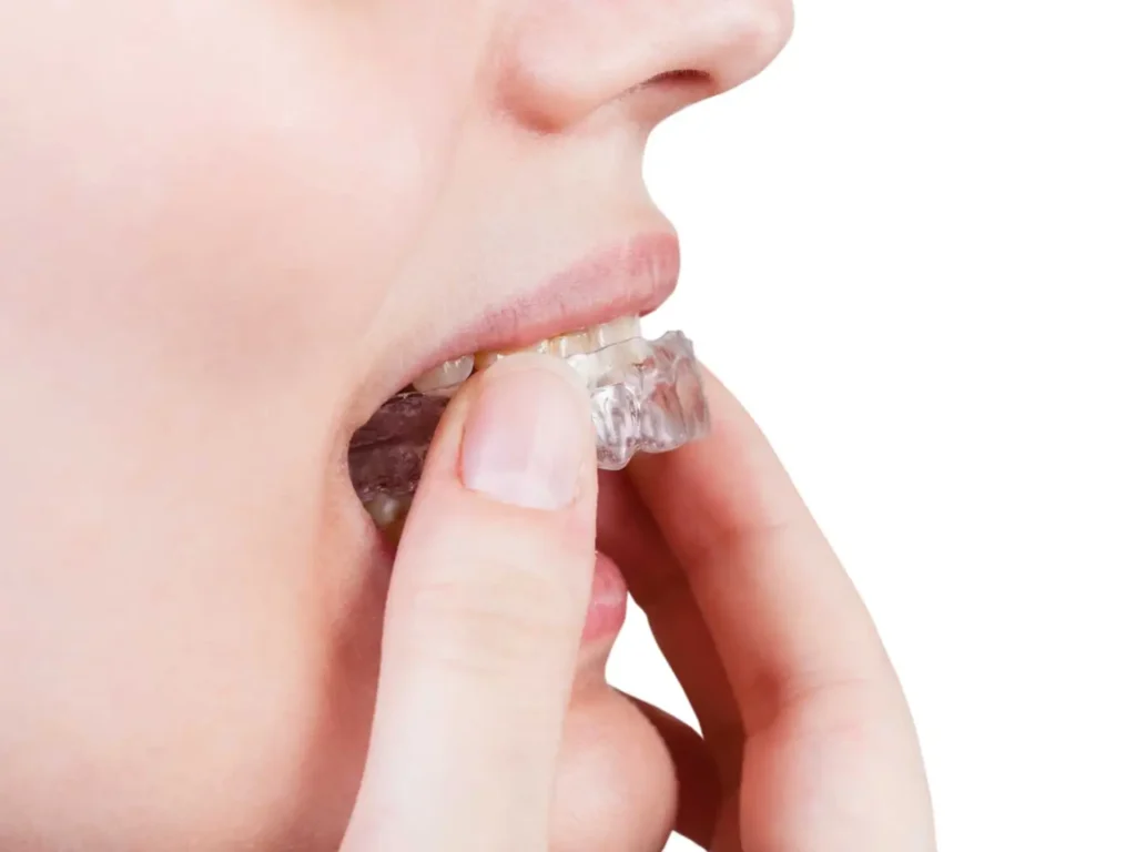 3 Things to Know about mouthguards