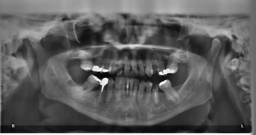 Are Dental X-Rays Truly Safe? Are dental x-rays truly safe? Sunset UT