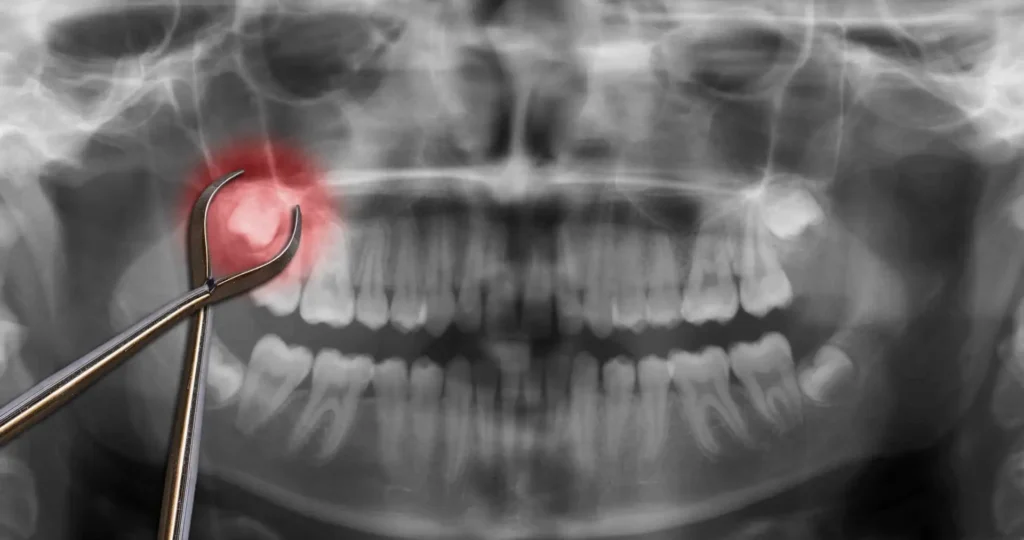More About Tooth Extraction Tooth Extraction