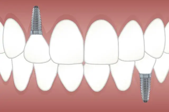 Are you a candidate for dental implants?
Sunset UT