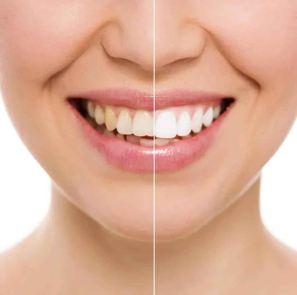 Why Trust Your Dentist For Teeth Whitening Instead Of Doing It At Home teeth whitening