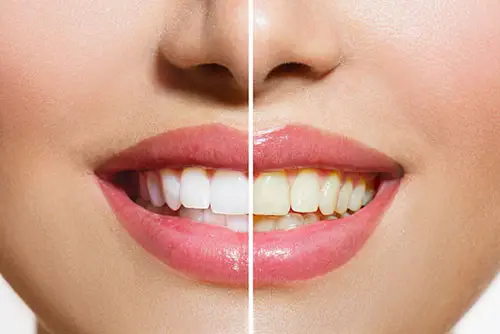 The science behind teeth whitening