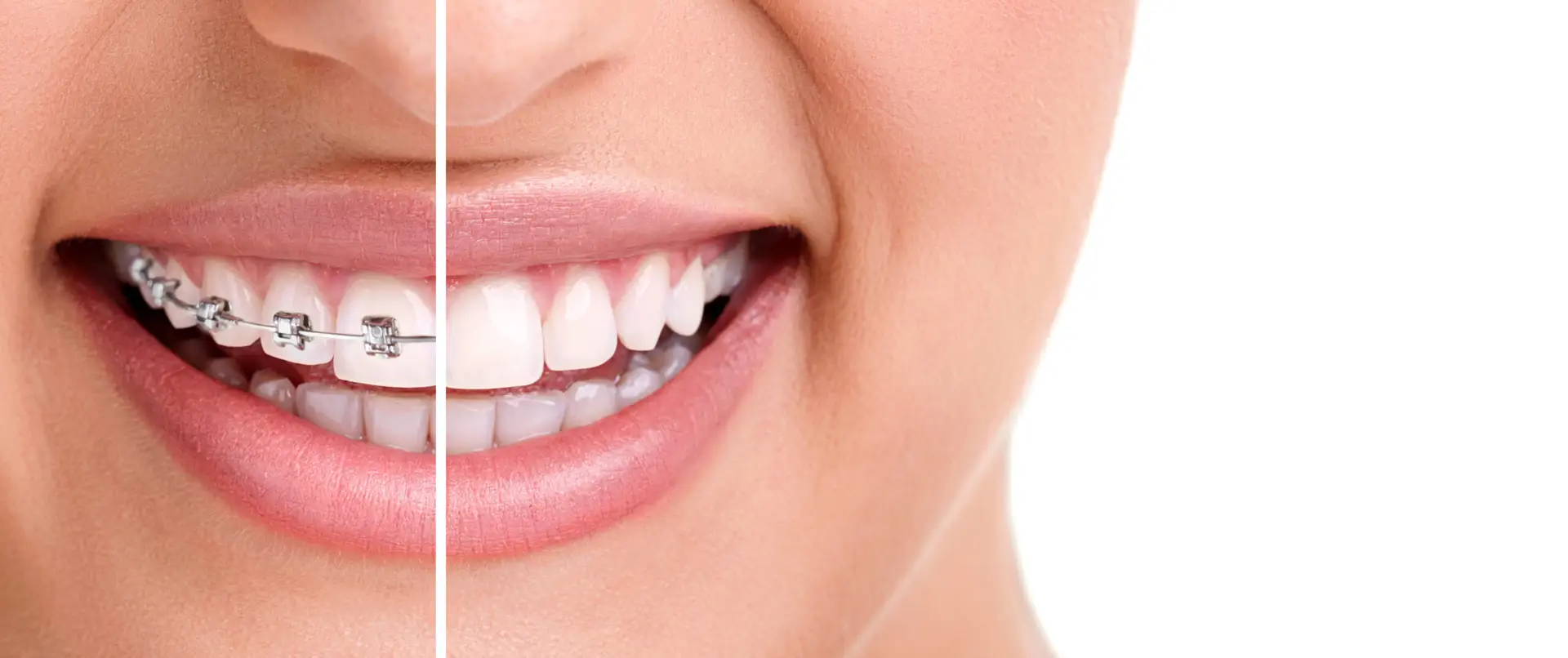 How Dentists Can Fix Gaps And Misaligned Teeth Without Braces